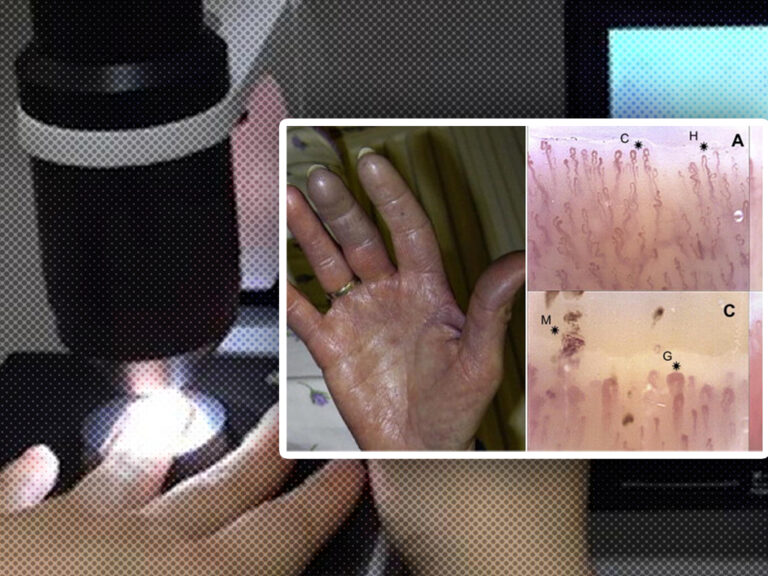 ตรวจเส้นเลือดฝอยหาโรค ? ระวังโดนหลอก!